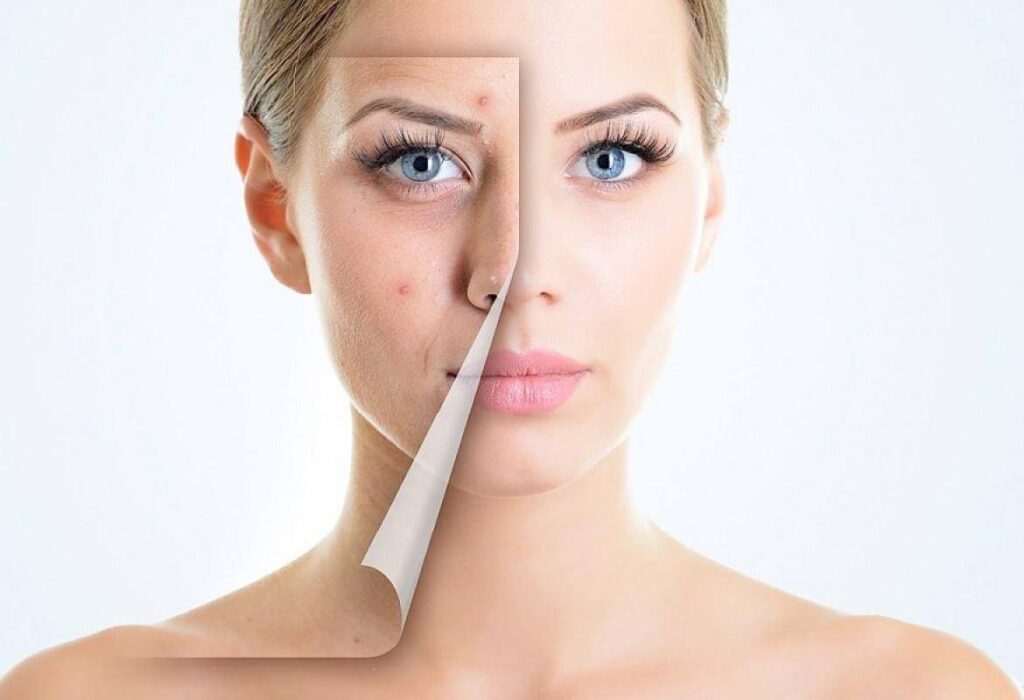acne treatment in the best brooklyn ny dermatology clinic