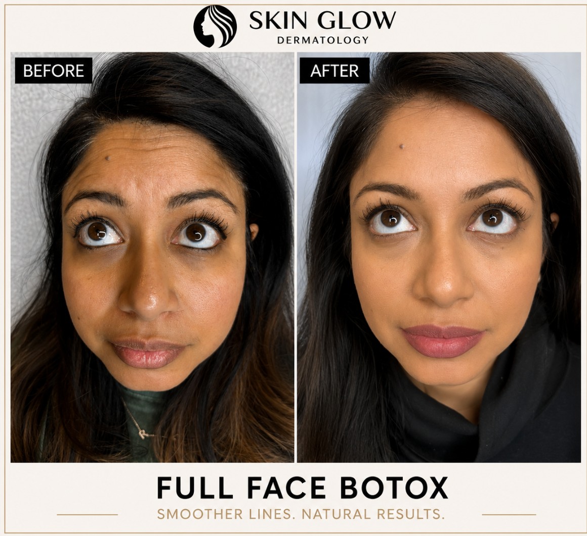 Full Face Botox before and after results showing smoother forehead lines, softened expression lines, and natural facial rejuvenation at Skin Glow Dermatology.