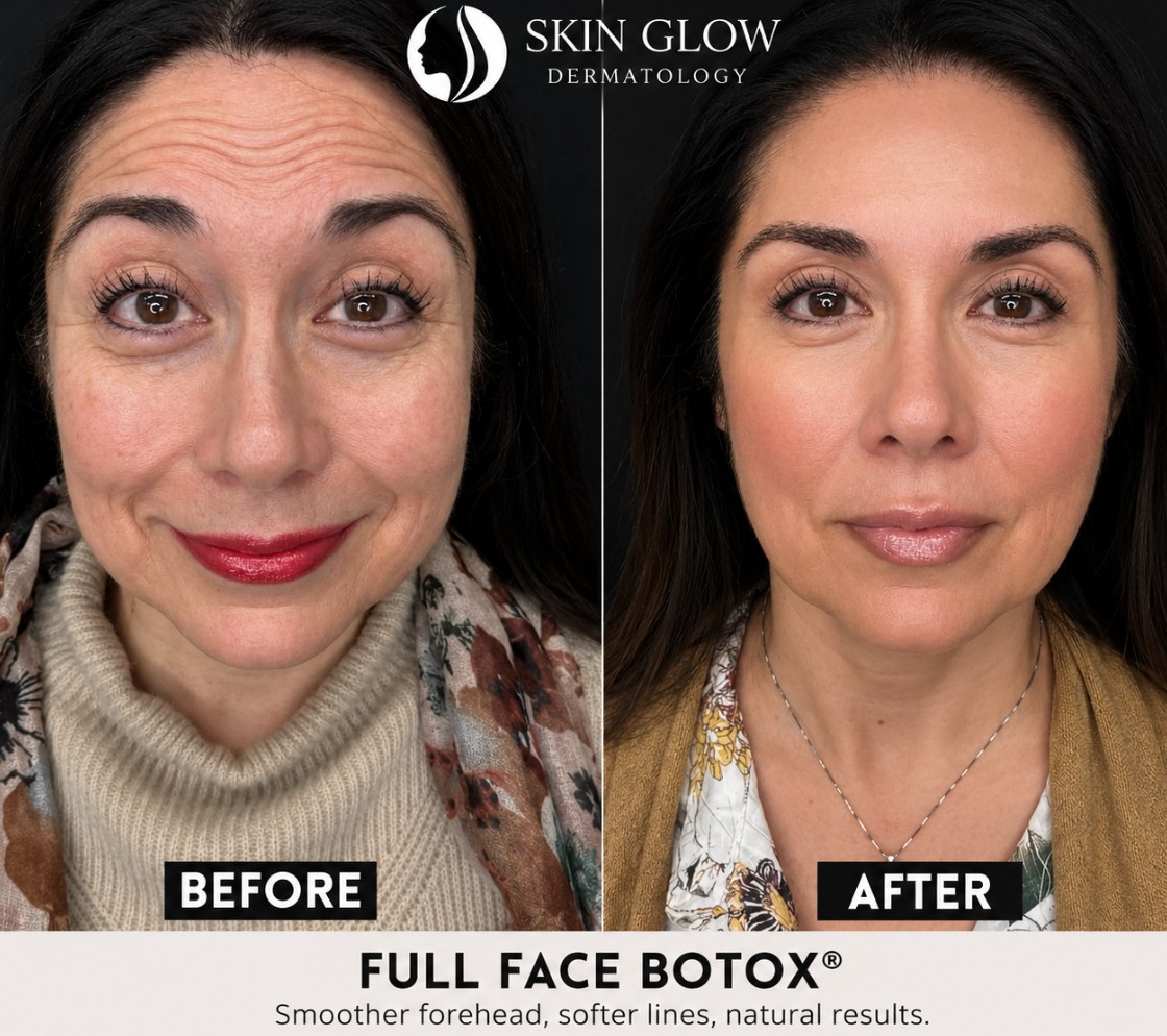 Full Face Botox® before and after results showing noticeable reduction of forehead lines, frown lines, and crow's feet with smoother, natural-looking facial rejuvenation at Skin Glow Dermatology.