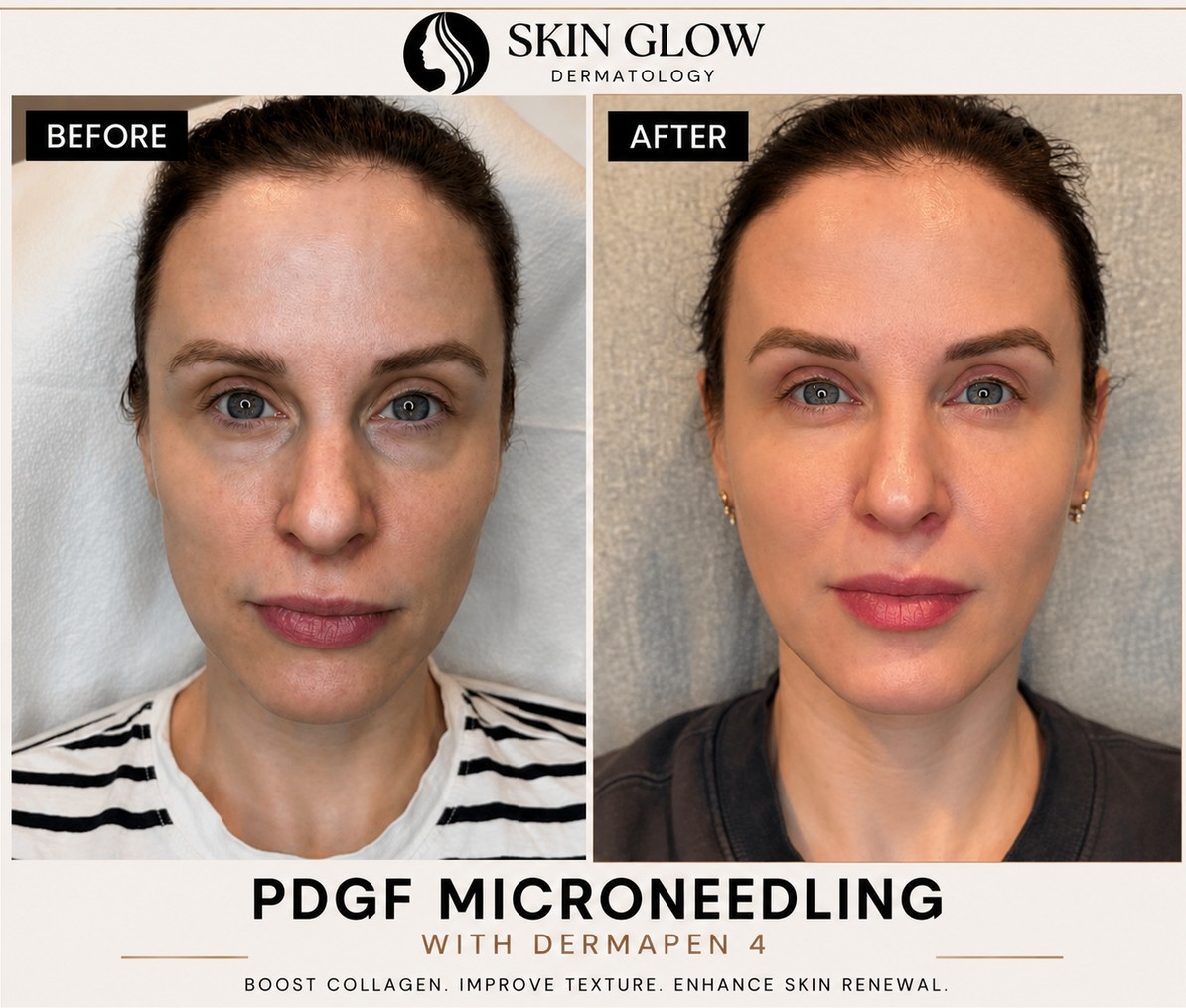 PDGF microneedling with Dermapen 4 before and after results showing smoother skin, improved texture, and a healthier complexion at Skin Glow Dermatology.